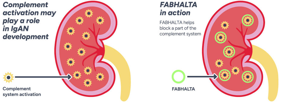 Complement activation may play a role in IgAN development. Fabhalta targets the activated complement system to help block its impact in your kidneys.