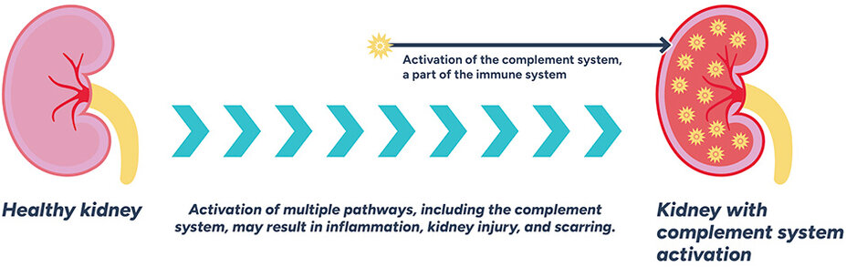 Activation of the complement system, a part of the immune system. Kidney with complement system activation